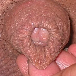 Part 1 of 3 Restored Foreskin Galeriebild