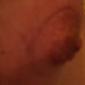 wunde Nippel Galeriebild