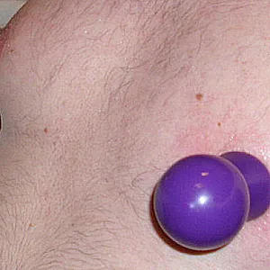 wunde Nippel Galeriebild