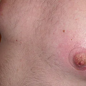 wunde Nippel Galeriebild