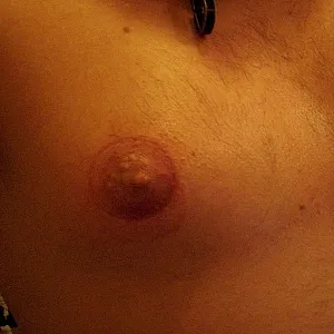 wunde Nippel Galeriebild