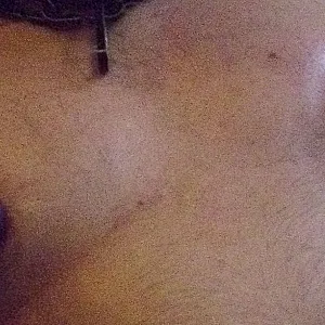 wunde Nippel Galeriebild