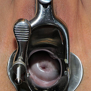 Nylons, Speculum  mit heißen Muttermund Galeriebild