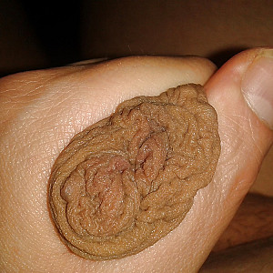 my foreskin gallery image