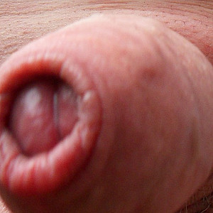 Penis modification gallery image