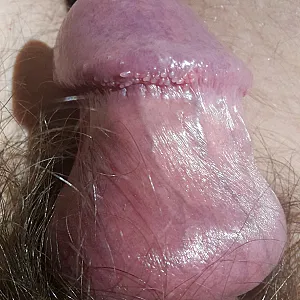 stretching foreskin gallery image