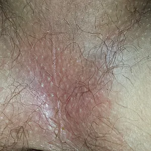 butt cock foreskin gallery image