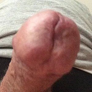 Hole in the pants. gallery image