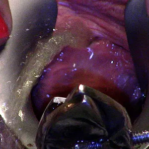 speculum pee gallery image