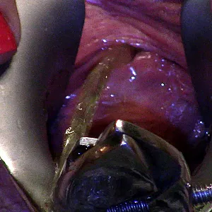 speculum pee gallery image