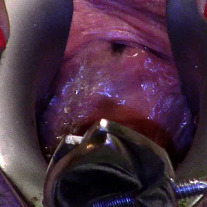 speculum pee gallery image