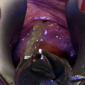 speculum pee gallery image