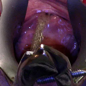 speculum pee gallery image