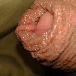 foreskin gallery image