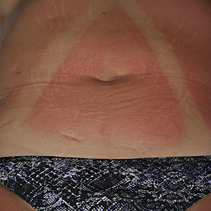 Sonnenbrand????? Galeriebild