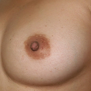 Nipples Galeriebild