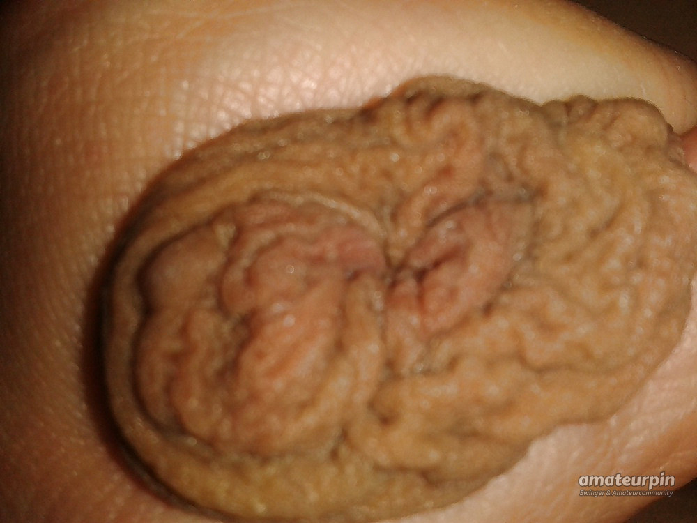 my foreskin gallery image