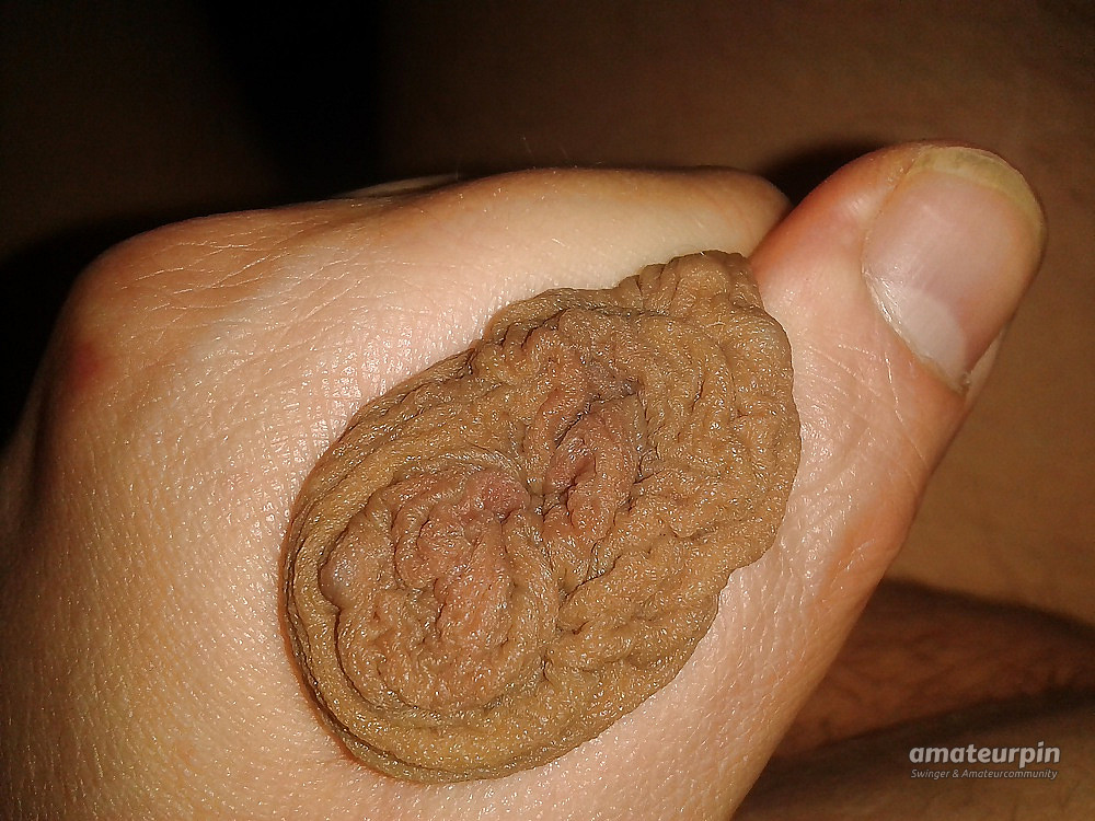 my foreskin gallery image