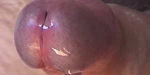 Spermastopper im Penis First Thumb Image