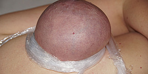 Brüste abgebunden First Thumb Image