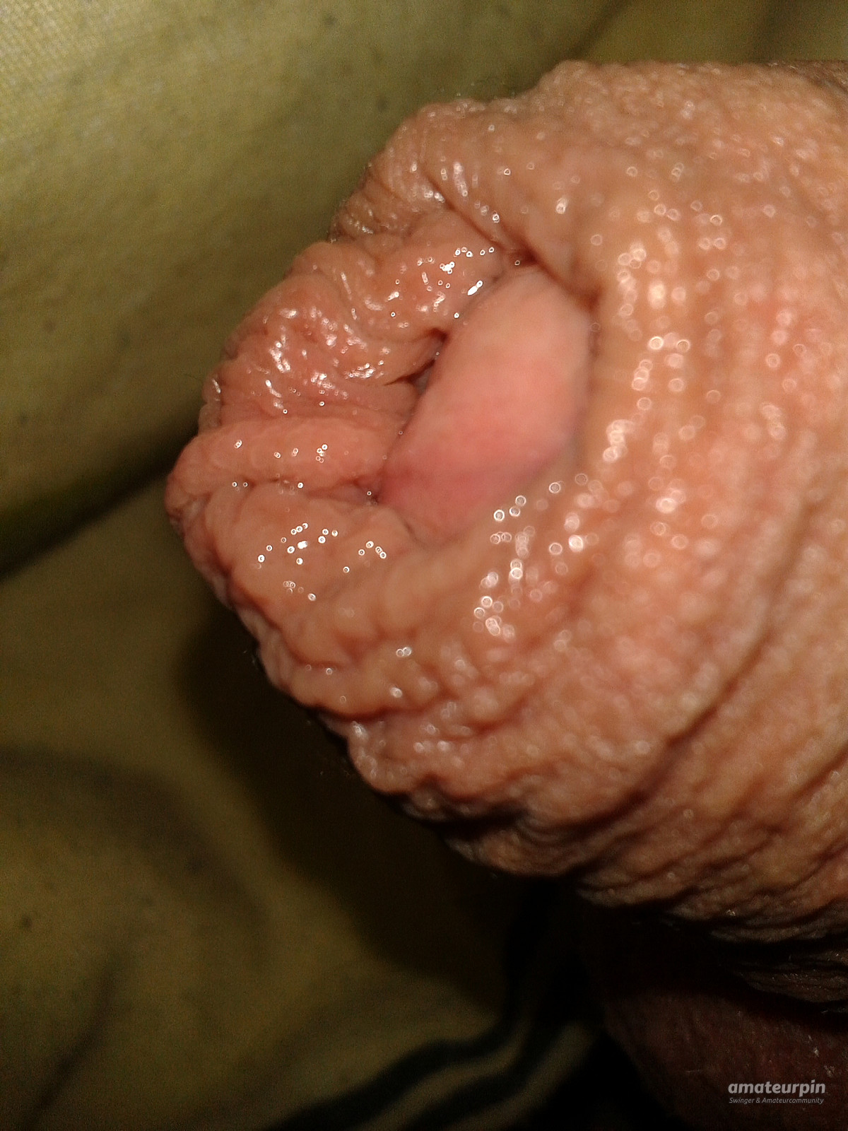 foreskin gallery image